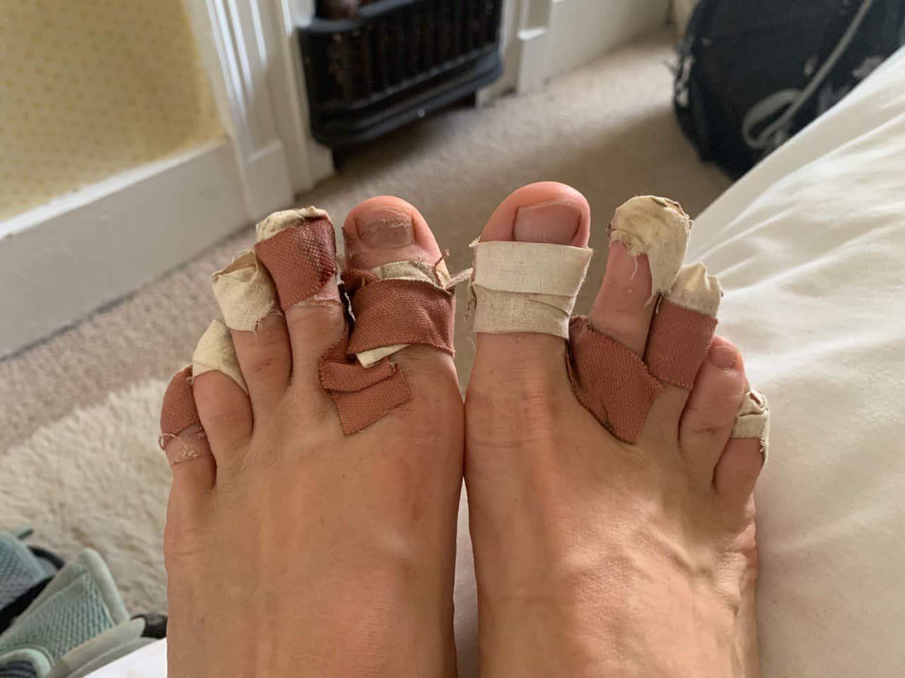 Blisters and bandaids on toes